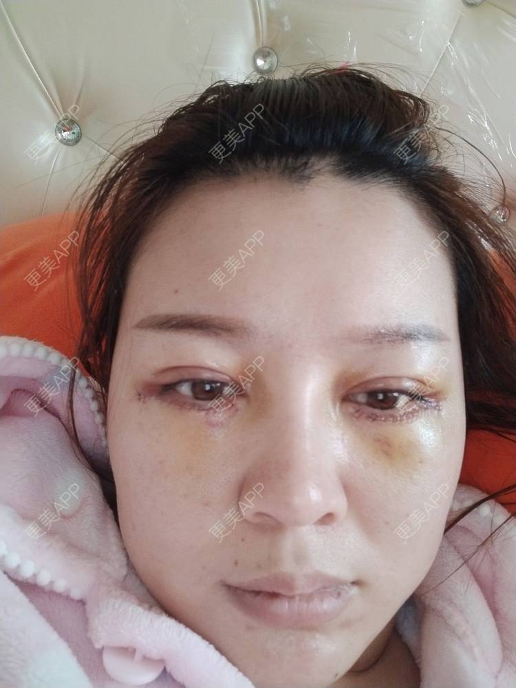 更美 - A孟先生的内切去眼袋经验 | 内切去眼袋 | 苏州