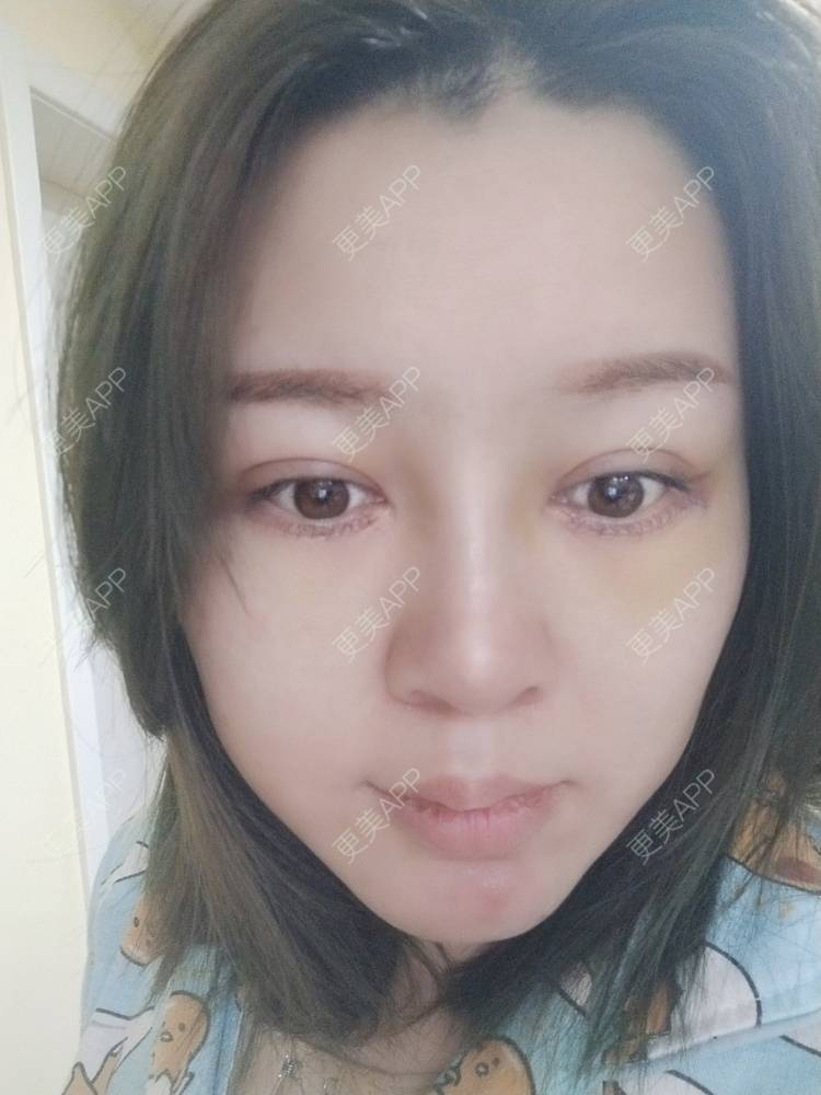 更美 - A孟先生的内切去眼袋经验 | 内切去眼袋 | 苏州