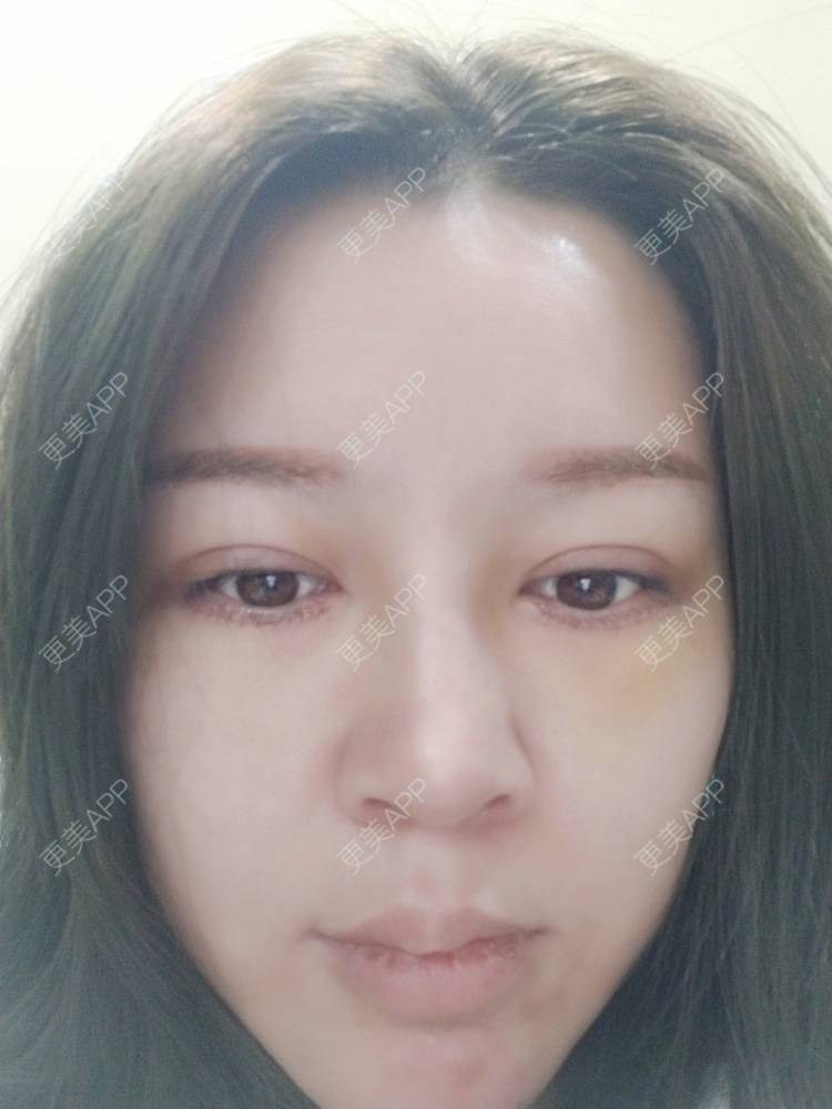 更美 - A孟先生的内切去眼袋经验 | 内切去眼袋 | 苏州