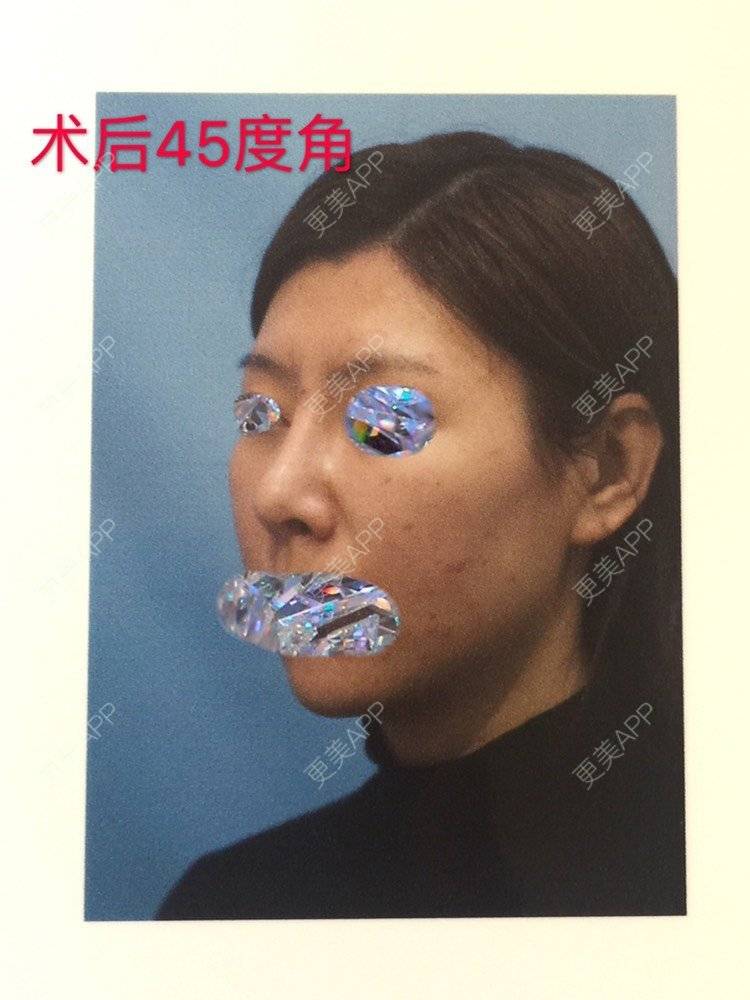 更美 - 更美用户X5OH30qY9K的肋软骨隆鼻经验 | 肋软骨隆鼻 | 鼻翼缩小 | 鼻孔矫正 | 自体肋软骨垫鼻基底