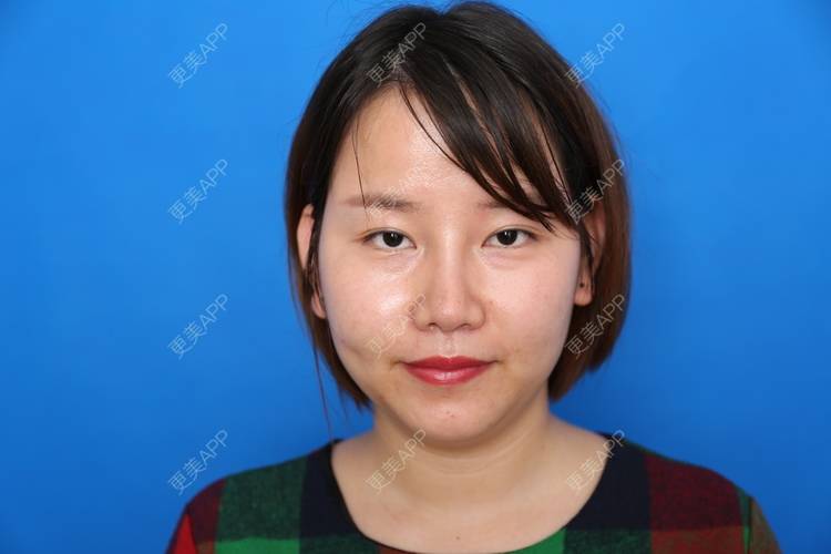 更美 - 猪猪小孩的鼻部修复经验 | 鼻部修复 | 注射溶脂瘦脸 | 双下巴溶脂 | 南宁