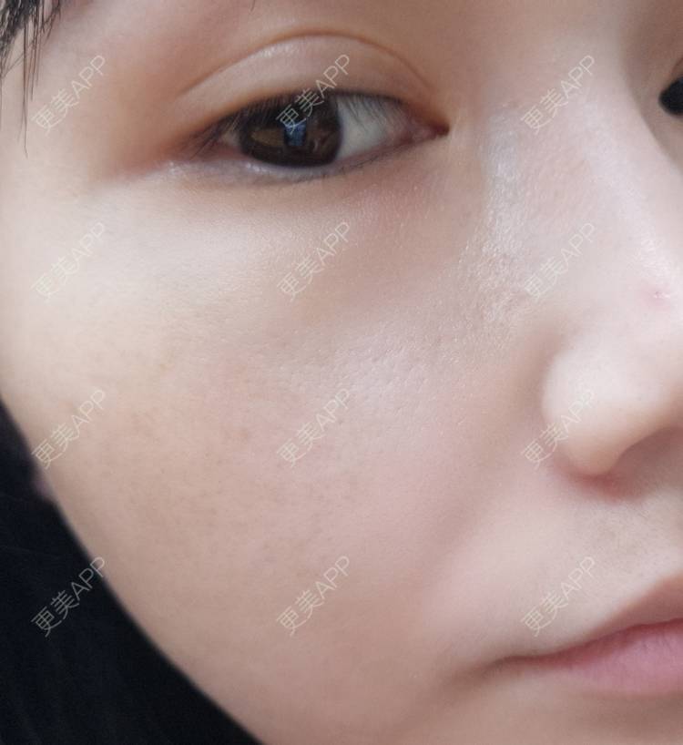 更美 - Rosebush20的水光项目经验 | 更美研究所 | 水光项目 | 光子嫩肤 | 南宁