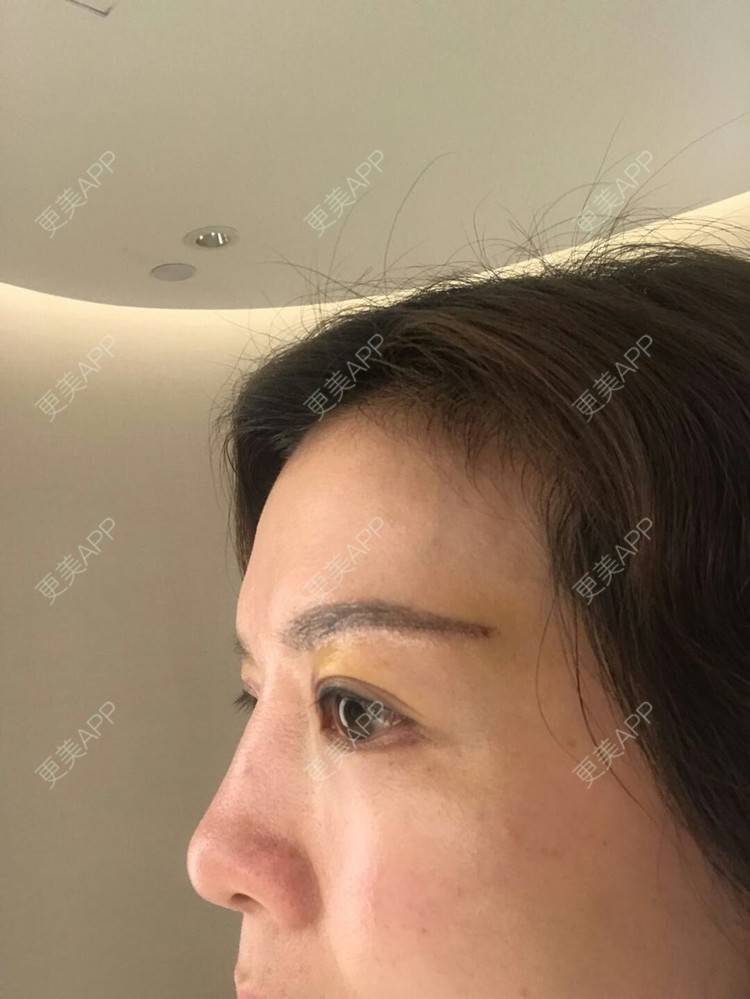 更美 - 雪之精灵的切眉经验 | 切眉 | 成都