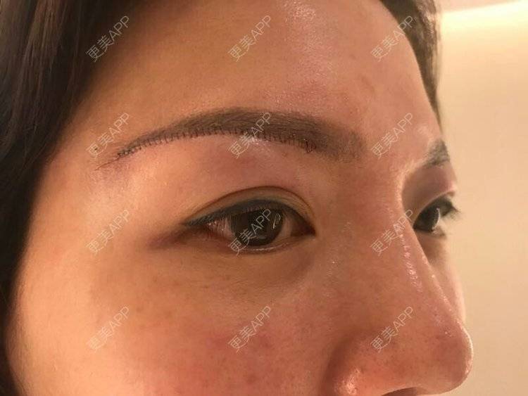 更美 - 雪之精灵的切眉经验 | 切眉 | 成都