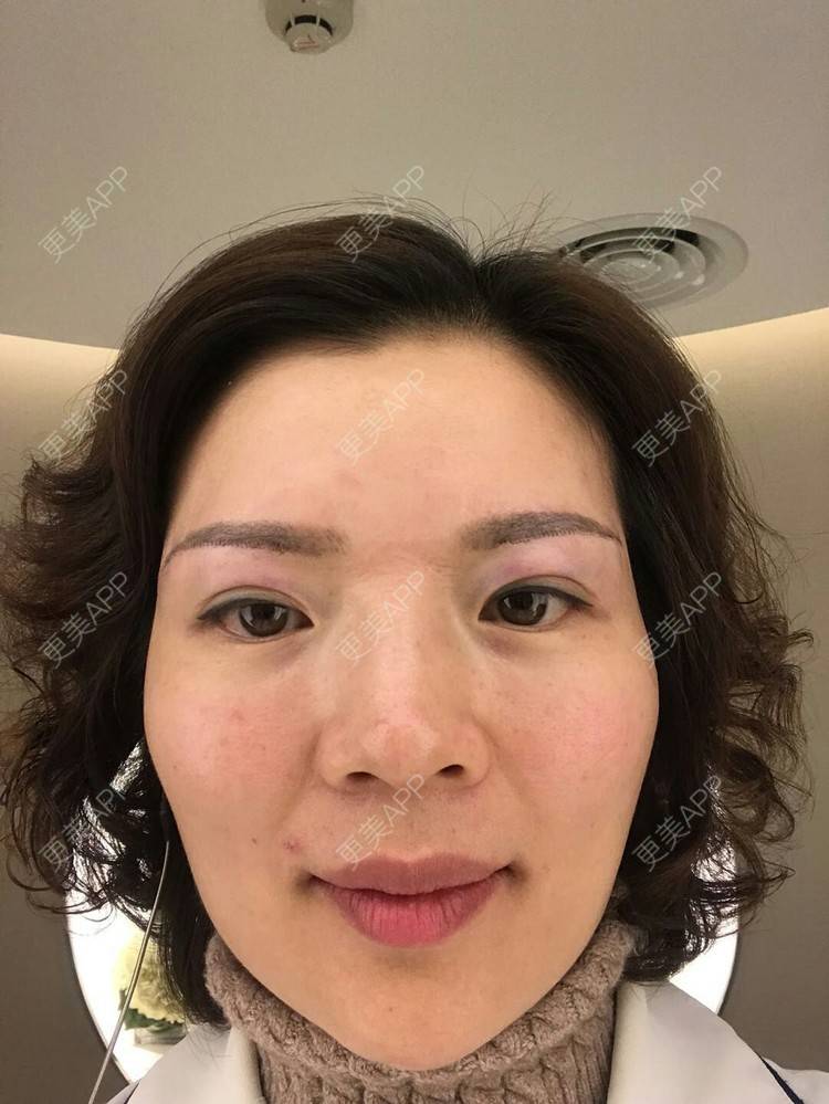 更美 - 雪之精灵的切眉经验 | 切眉 | 成都