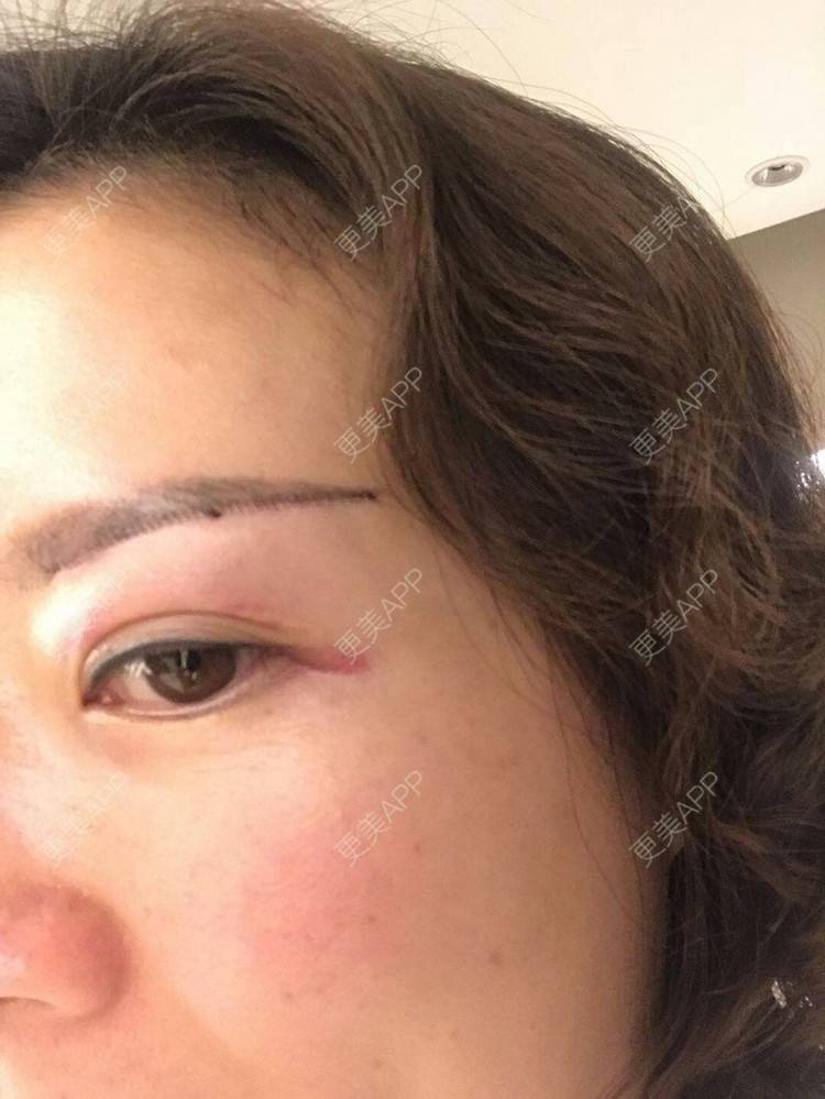 更美 - 雪之精灵的切眉经验 | 切眉 | 成都