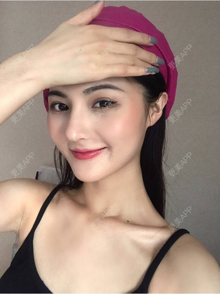 更美 - 15*******34的鼻部多项经验 | 肋软骨隆鼻 | 鼻翼缩小 | 鼻部硅胶假体取出 | 鼻部多项 | 鼻小柱延长