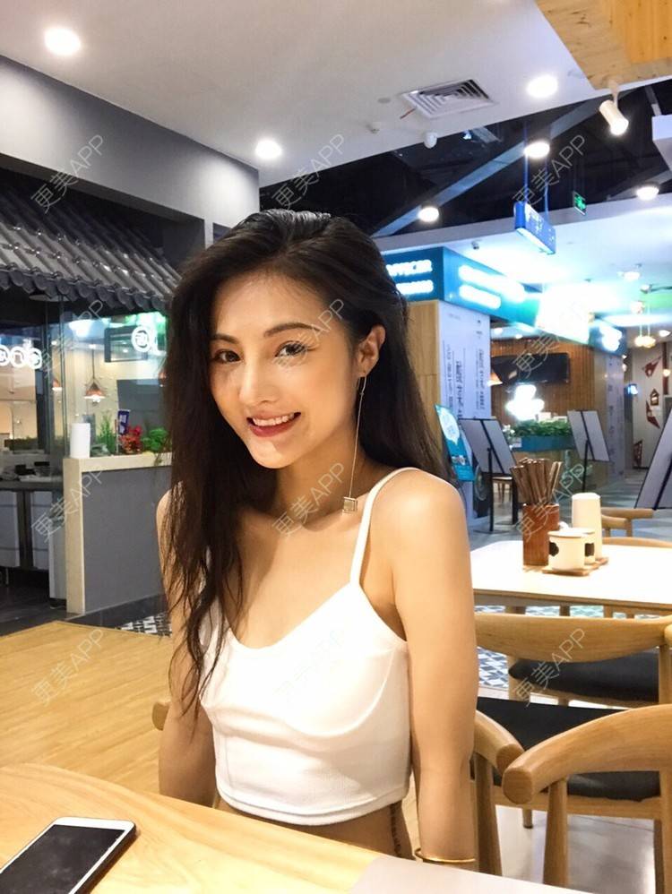 更美 - 15*******34的鼻部多项经验 | 肋软骨隆鼻 | 鼻翼缩小 | 鼻部硅胶假体取出 | 鼻部多项 | 鼻小柱延长