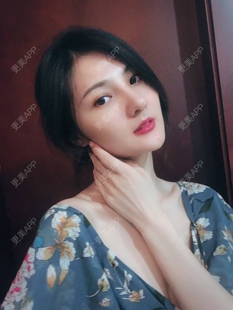 更美 - 15*******34的鼻部多项经验 | 肋软骨隆鼻 | 鼻翼缩小 | 鼻部硅胶假体取出 | 鼻部多项 | 鼻小柱延长