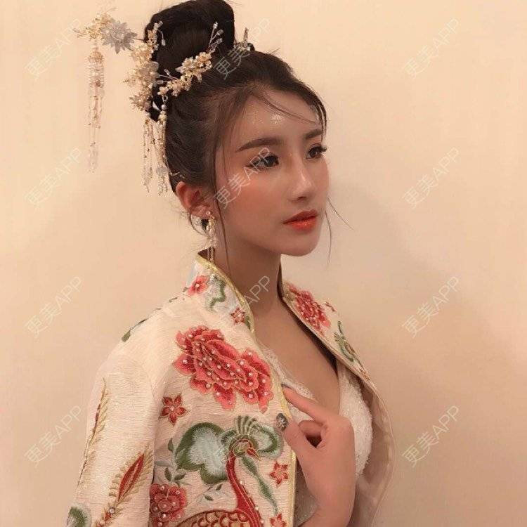 更美 - 今天可爱百分百的自体脂肪丰苹果肌经验 | 自体脂肪丰苹果肌 | 自体脂肪丰面颊 | 自体脂肪丰太阳穴 | 自体脂肪丰额头 | 杭州 | 自体脂肪全面部填充