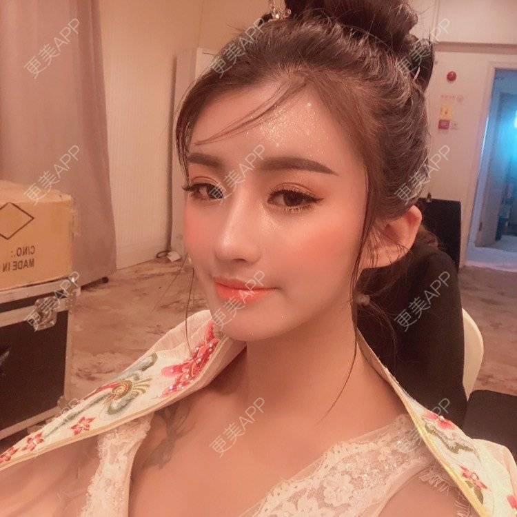 更美 - 今天可爱百分百的自体脂肪丰苹果肌经验 | 自体脂肪丰苹果肌 | 自体脂肪丰面颊 | 自体脂肪丰太阳穴 | 自体脂肪丰额头 | 杭州 | 自体脂肪全面部填充