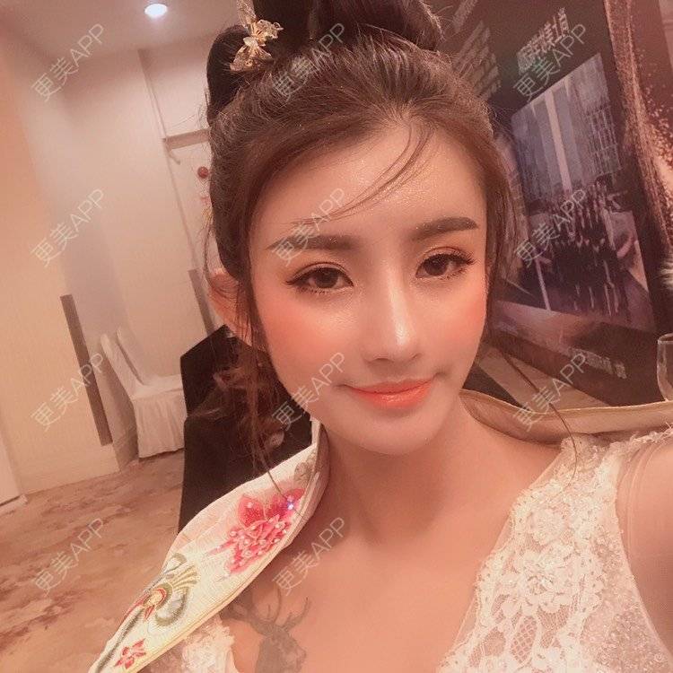 更美 - 今天可爱百分百的自体脂肪丰苹果肌经验 | 自体脂肪丰苹果肌 | 自体脂肪丰面颊 | 自体脂肪丰太阳穴 | 自体脂肪丰额头 | 杭州 | 自体脂肪全面部填充