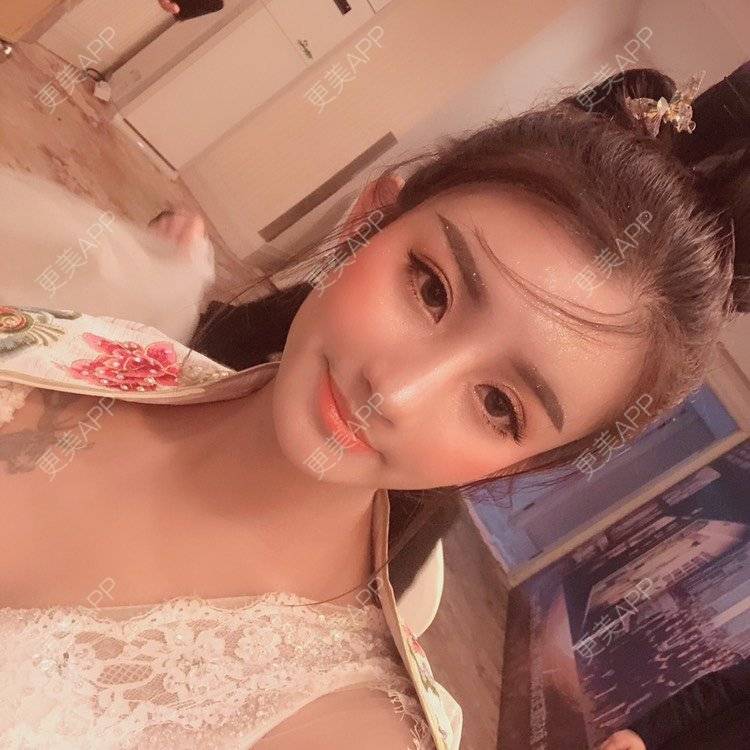 更美 - 今天可爱百分百的自体脂肪丰苹果肌经验 | 自体脂肪丰苹果肌 | 自体脂肪丰面颊 | 自体脂肪丰太阳穴 | 自体脂肪丰额头 | 杭州 | 自体脂肪全面部填充