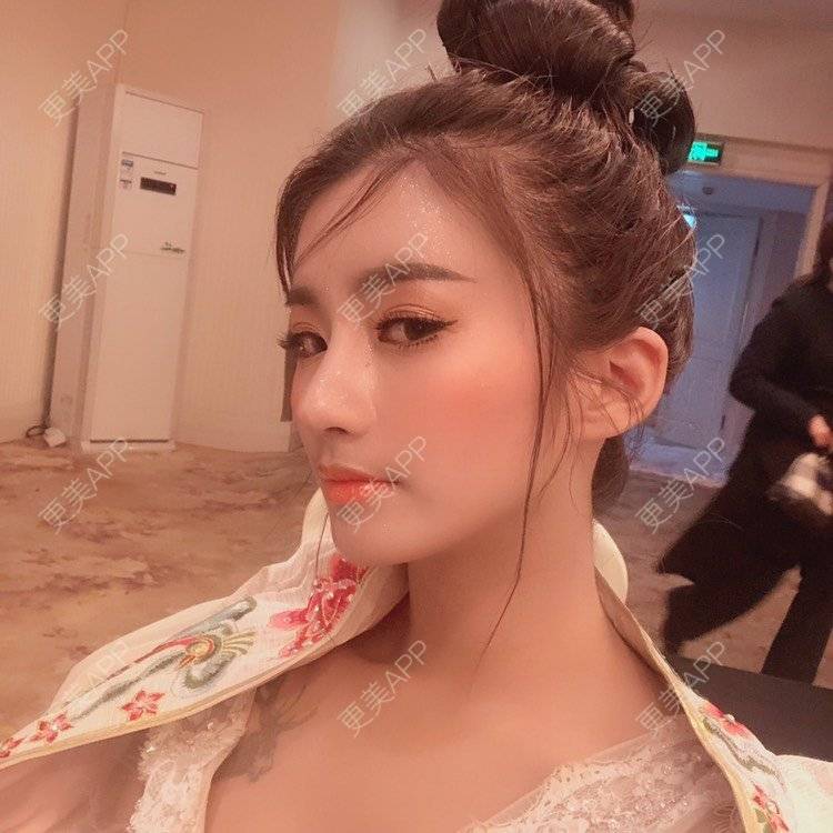 更美 - 今天可爱百分百的自体脂肪丰苹果肌经验 | 自体脂肪丰苹果肌 | 自体脂肪丰面颊 | 自体脂肪丰太阳穴 | 自体脂肪丰额头 | 杭州 | 自体脂肪全面部填充