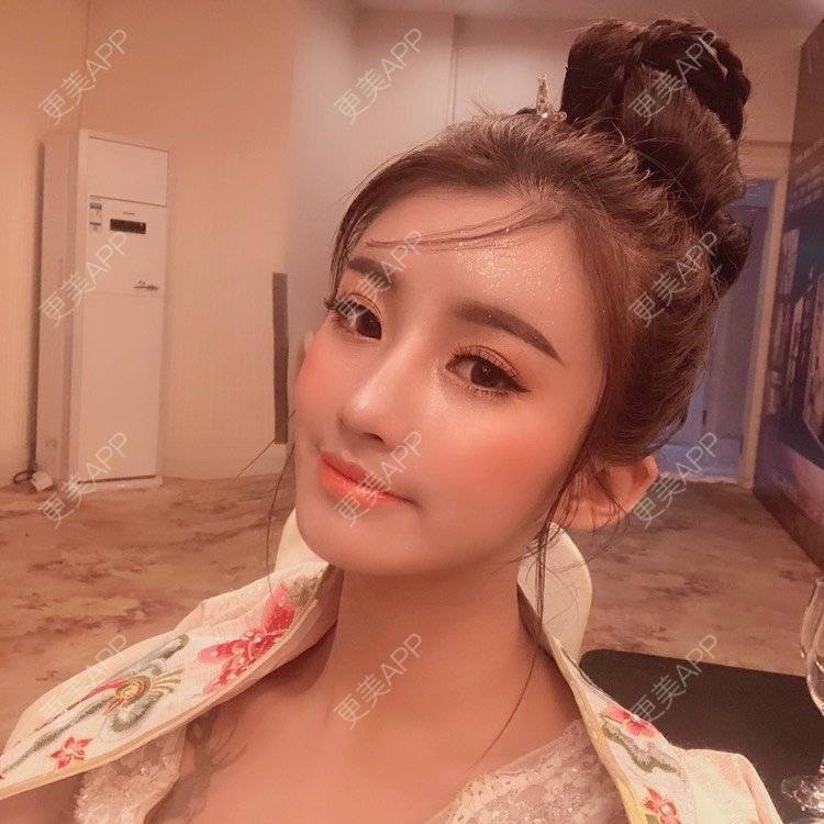 更美 - 今天可爱百分百的自体脂肪丰苹果肌经验 | 自体脂肪丰苹果肌 | 自体脂肪丰面颊 | 自体脂肪丰太阳穴 | 自体脂肪丰额头 | 杭州 | 自体脂肪全面部填充