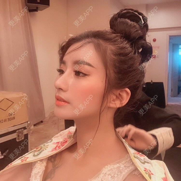 更美 - 今天可爱百分百的自体脂肪丰苹果肌经验 | 自体脂肪丰苹果肌 | 自体脂肪丰面颊 | 自体脂肪丰太阳穴 | 自体脂肪丰额头 | 杭州 | 自体脂肪全面部填充