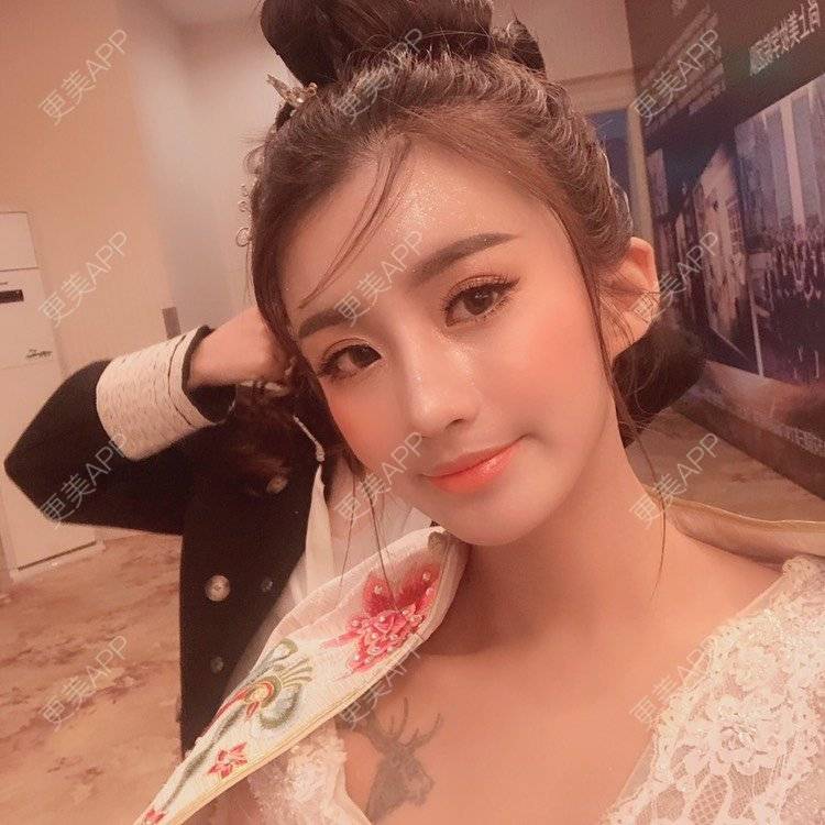 更美 - 今天可爱百分百的自体脂肪丰苹果肌经验 | 自体脂肪丰苹果肌 | 自体脂肪丰面颊 | 自体脂肪丰太阳穴 | 自体脂肪丰额头 | 杭州 | 自体脂肪全面部填充