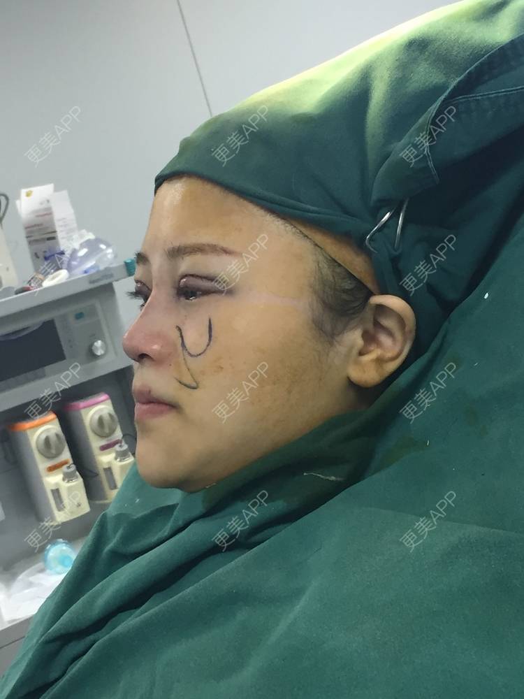 更美 - 范小碗的自体脂肪丰苹果肌经验 | 视频日记 | 自体脂肪丰苹果肌 | 自体脂肪垫鼻基底 | 上海