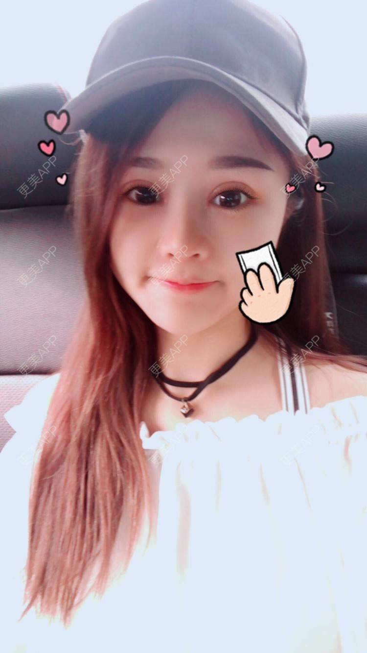 更美 - 范小碗的自体脂肪丰苹果肌经验 | 自体脂肪丰苹果肌 | 自体脂肪垫鼻基底 | 上海