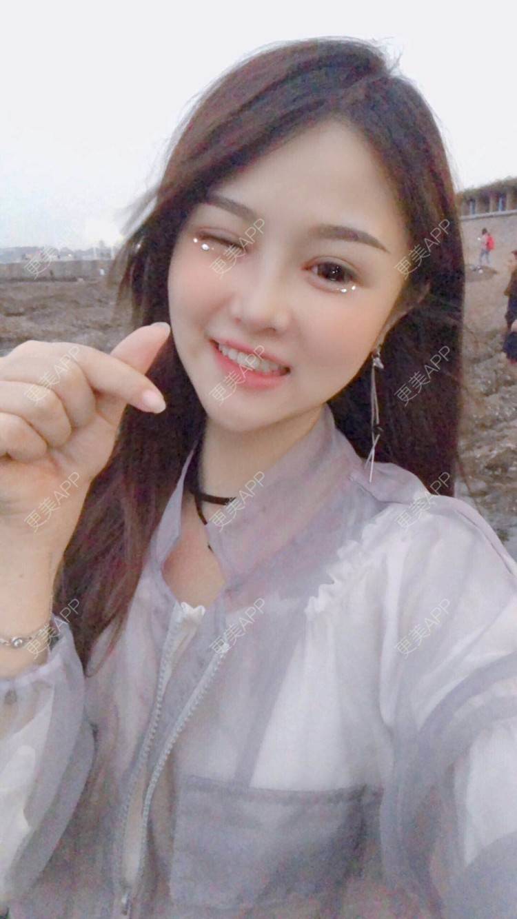 更美 - 范小碗的自体脂肪丰苹果肌经验 | 自体脂肪丰苹果肌 | 自体脂肪垫鼻基底 | 上海