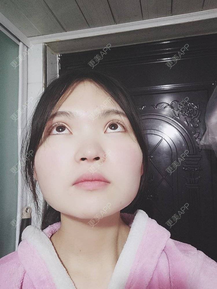 更美 - 刘晋军 医生的全切双眼皮经验 | 眼部多项 | 全切双眼皮 | 南京 | 双眼皮