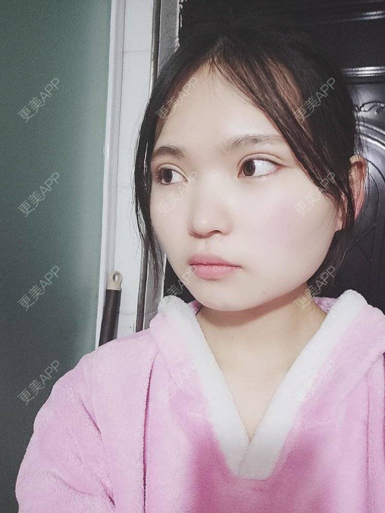 更美 - 刘晋军 医生的全切双眼皮经验 | 眼部多项 | 全切双眼皮 | 南京 | 双眼皮