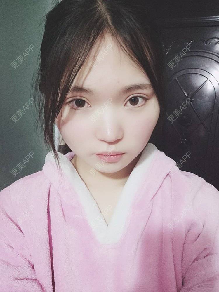 更美 - 刘晋军 医生的全切双眼皮经验 | 眼部多项 | 全切双眼皮 | 南京 | 双眼皮