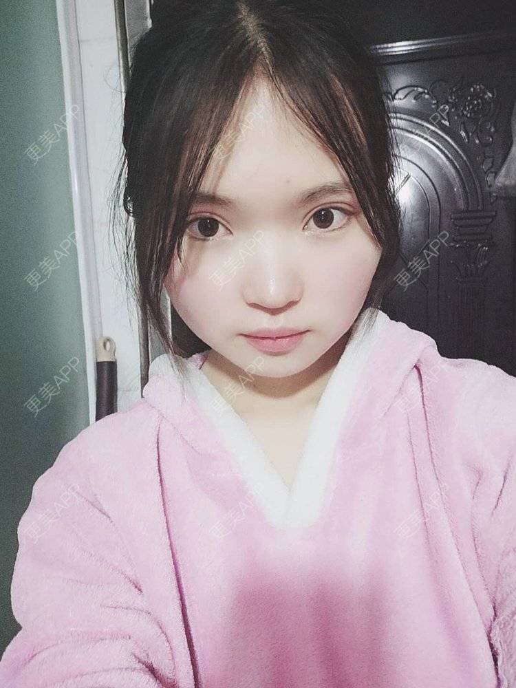 更美 - 刘晋军 医生的鼻部硅胶假体取出经验 | 鼻部修复 | 南京 | 鼻形态修复 | 鼻部硅胶假体取出