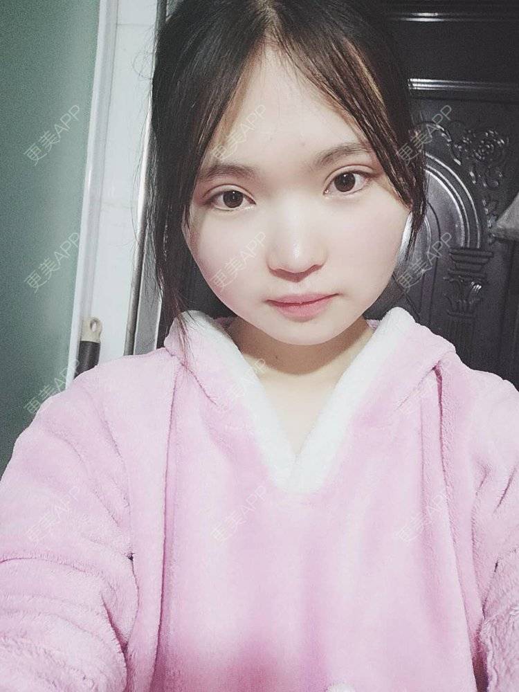 更美 - 刘晋军 医生的鼻部硅胶假体取出经验 | 鼻部修复 | 南京 | 鼻形态修复 | 鼻部硅胶假体取出