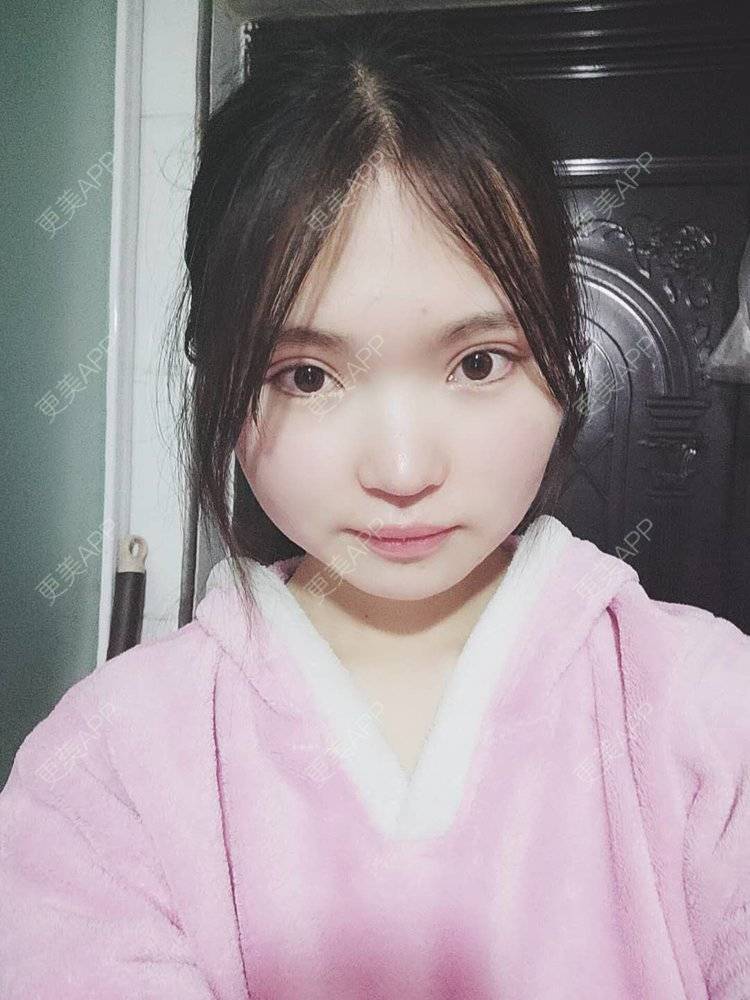 更美 - 刘晋军 医生的鼻部硅胶假体取出经验 | 鼻部修复 | 南京 | 鼻形态修复 | 鼻部硅胶假体取出