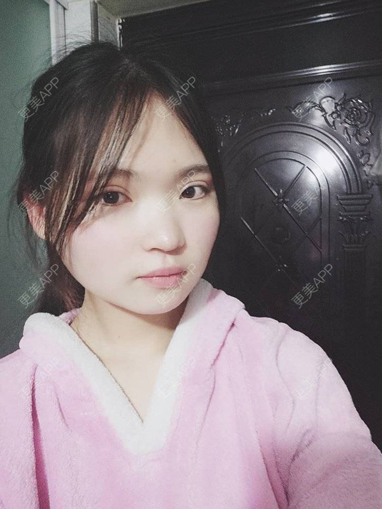 更美 - 刘晋军 医生的鼻部硅胶假体取出经验 | 鼻部修复 | 南京 | 鼻形态修复 | 鼻部硅胶假体取出