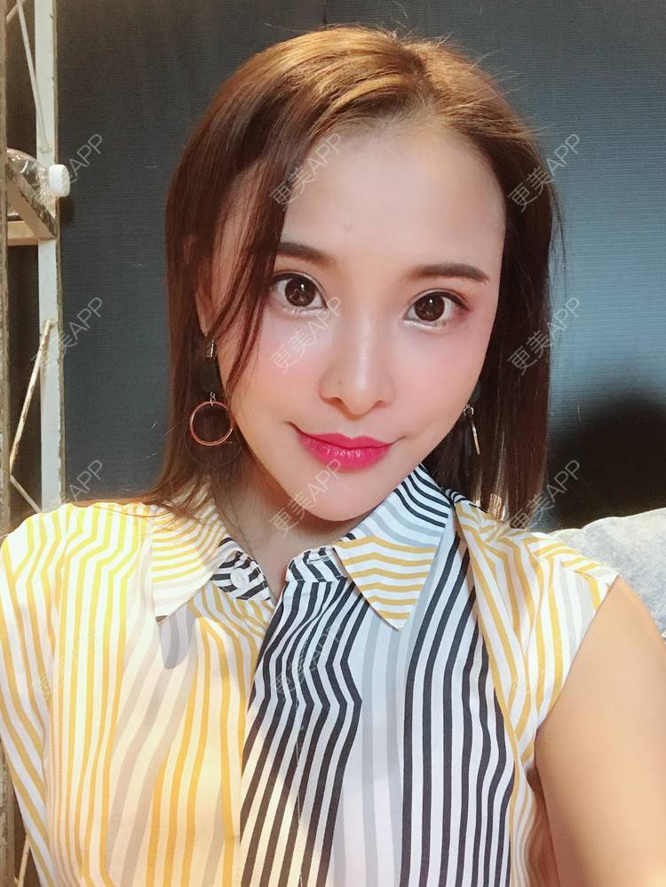 迷鹿m的玻尿酸下巴日记