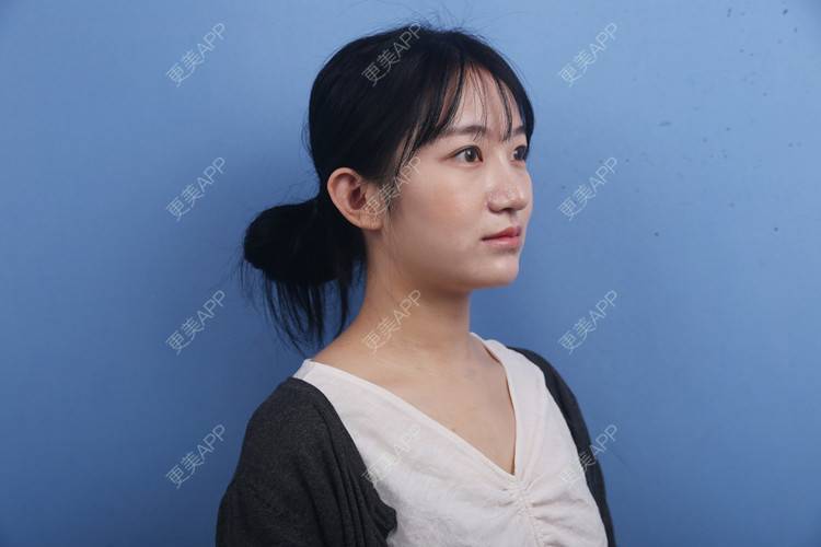 更美 - 瑶瑶就要瑶瑶的颈部经验 | 广州 | 颈部 | 玻尿酸颈纹