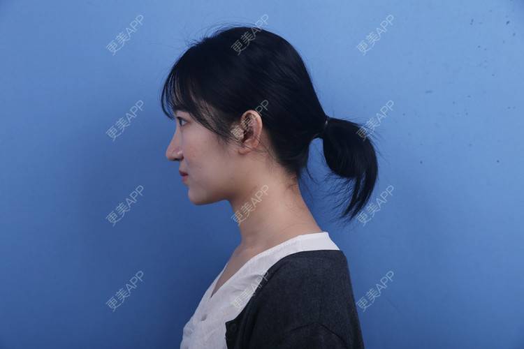 更美 - 瑶瑶就要瑶瑶的颈部经验 | 广州 | 颈部 | 玻尿酸颈纹