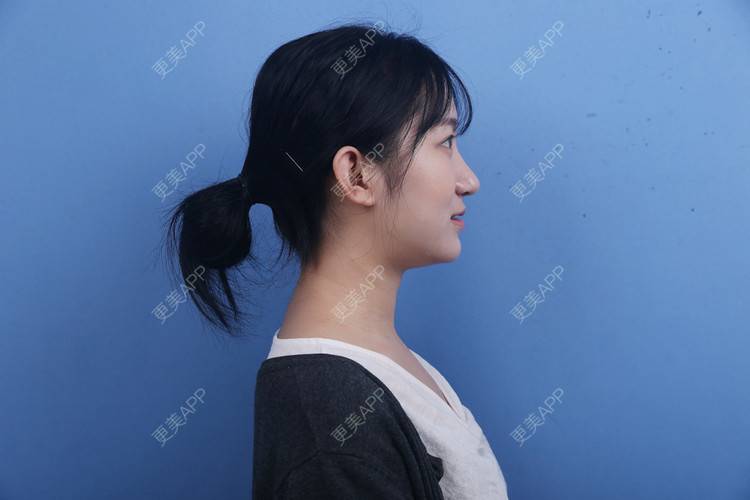 更美 - 瑶瑶就要瑶瑶的颈部经验 | 广州 | 颈部 | 玻尿酸颈纹