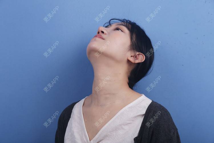 更美 - 瑶瑶就要瑶瑶的颈部经验 | 广州 | 颈部 | 玻尿酸颈纹