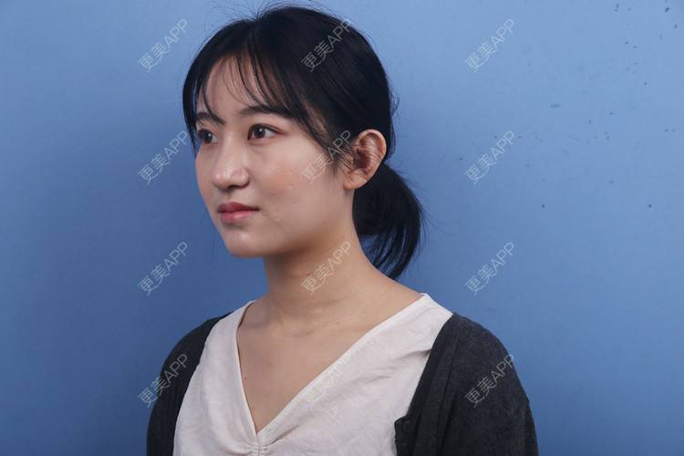 更美 - 瑶瑶就要瑶瑶的颈部经验 | 广州 | 颈部 | 玻尿酸颈纹