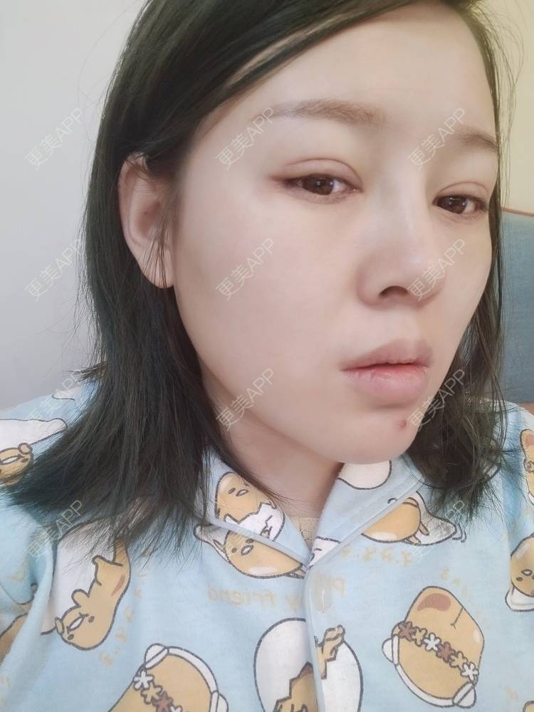 更美 - A孟先生的内切去眼袋经验 | 内切去眼袋 | 苏州