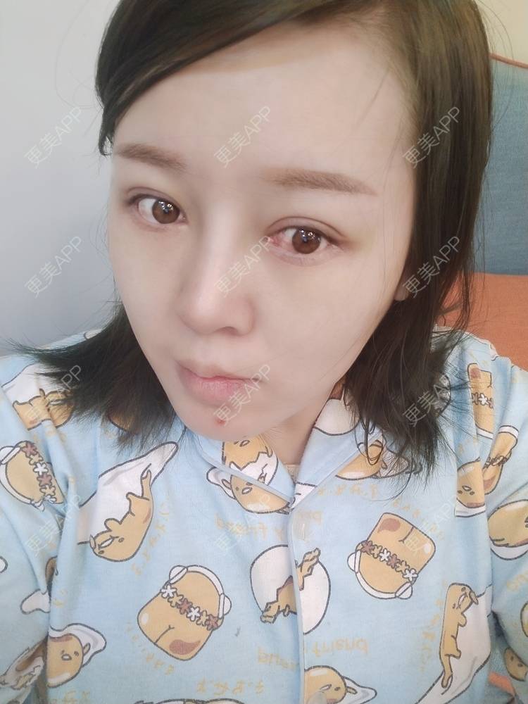 更美 - A孟先生的内切去眼袋经验 | 内切去眼袋 | 苏州