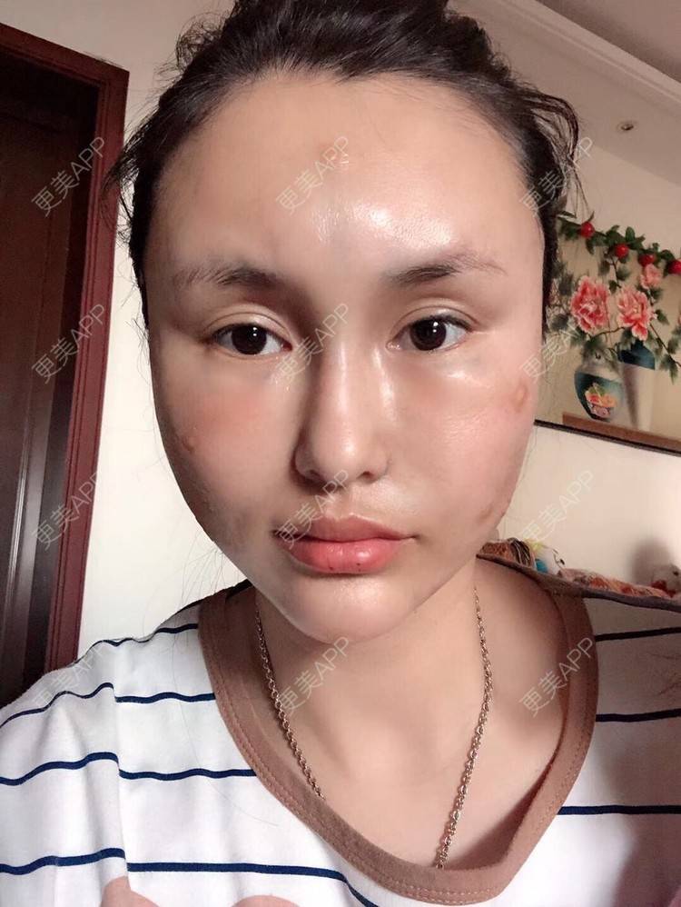 更美 - 13*******06的自体脂肪丰苹果肌经验 | 自体脂肪垫下巴 | 自体脂肪垫鼻基底 | 自体脂肪全面部填充 | 自体脂肪丰唇 | 自体脂肪丰苹果肌 | 大连
