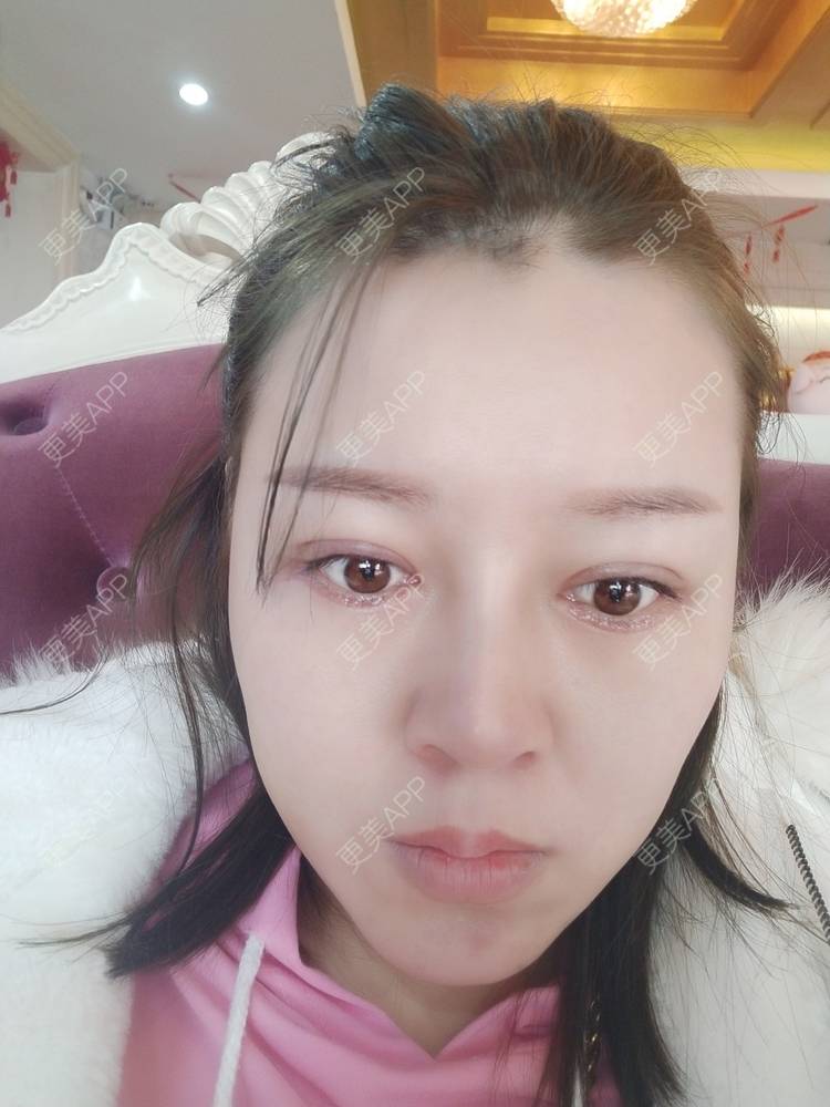 更美 - A孟先生的内切去眼袋经验 | 内切去眼袋 | 苏州