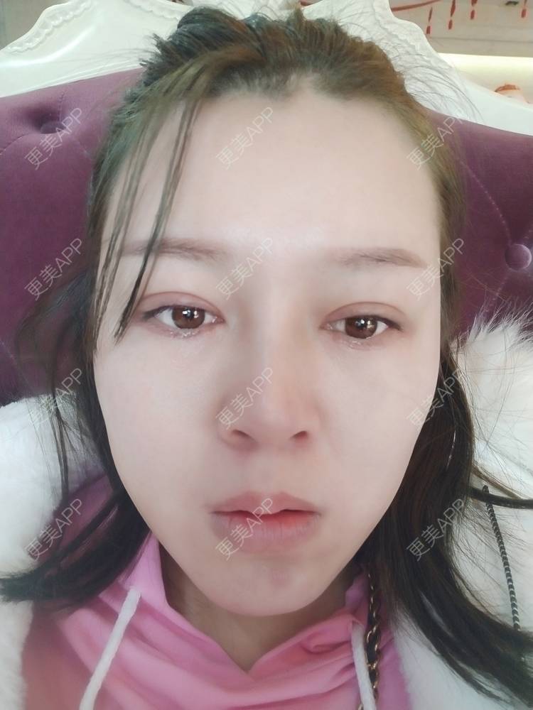 更美 - A孟先生的内切去眼袋经验 | 内切去眼袋 | 苏州