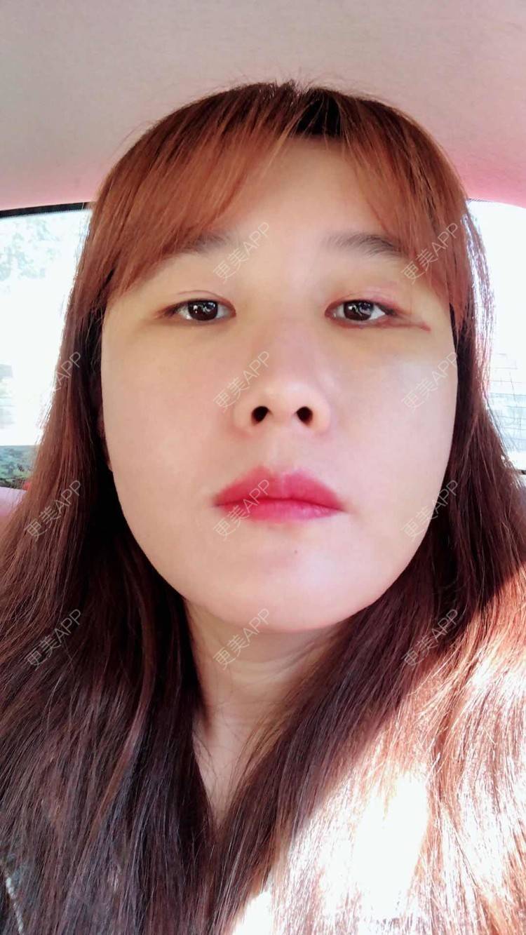 更美 - 伤痕累累累。的自体脂肪全面部填充经验 | 自体脂肪面部填充 | 自体脂肪全面部填充 | 自体脂肪填充面部细纹