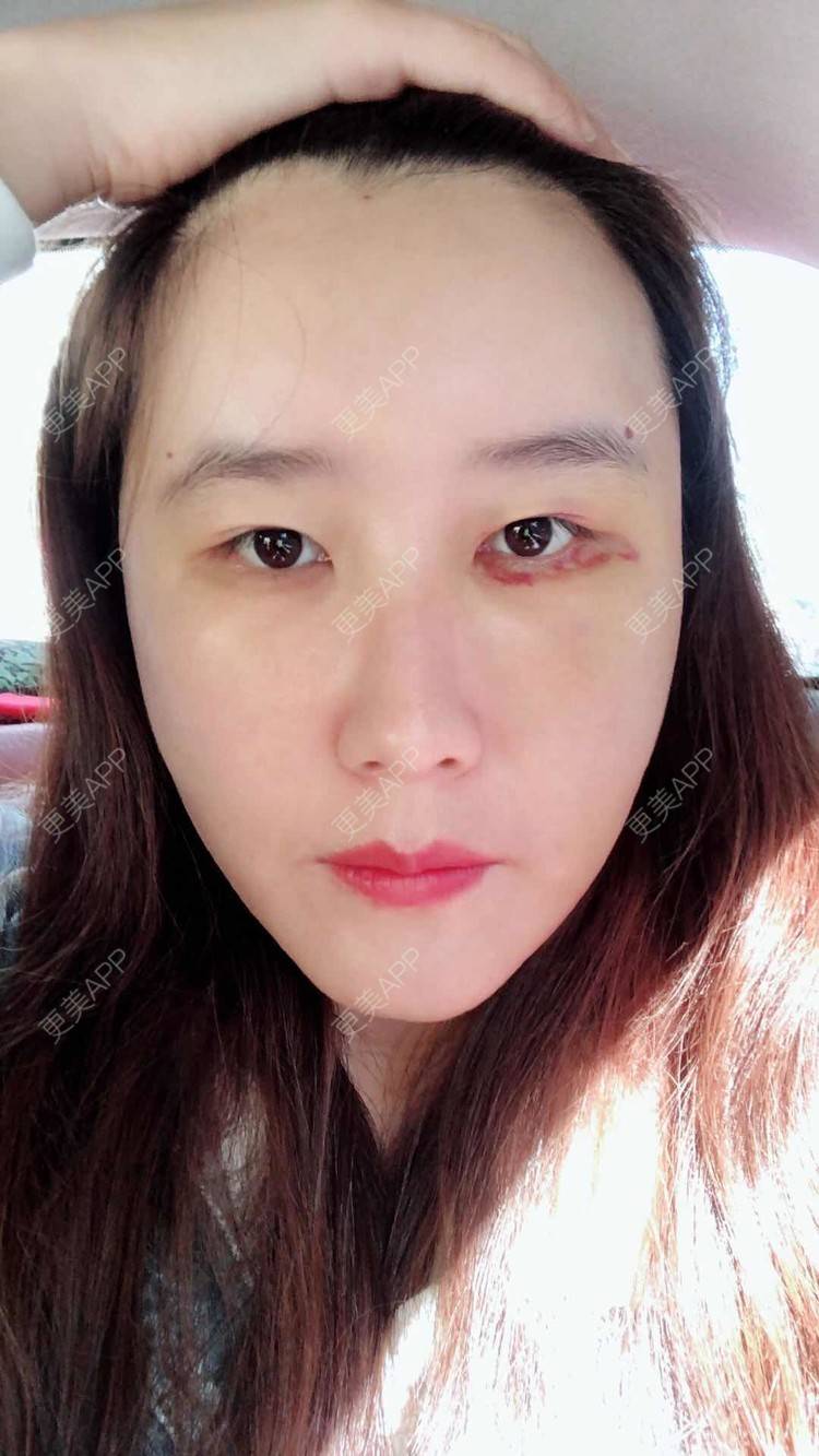 更美 - 伤痕累累累。的自体脂肪全面部填充经验 | 自体脂肪面部填充 | 自体脂肪全面部填充 | 自体脂肪填充面部细纹