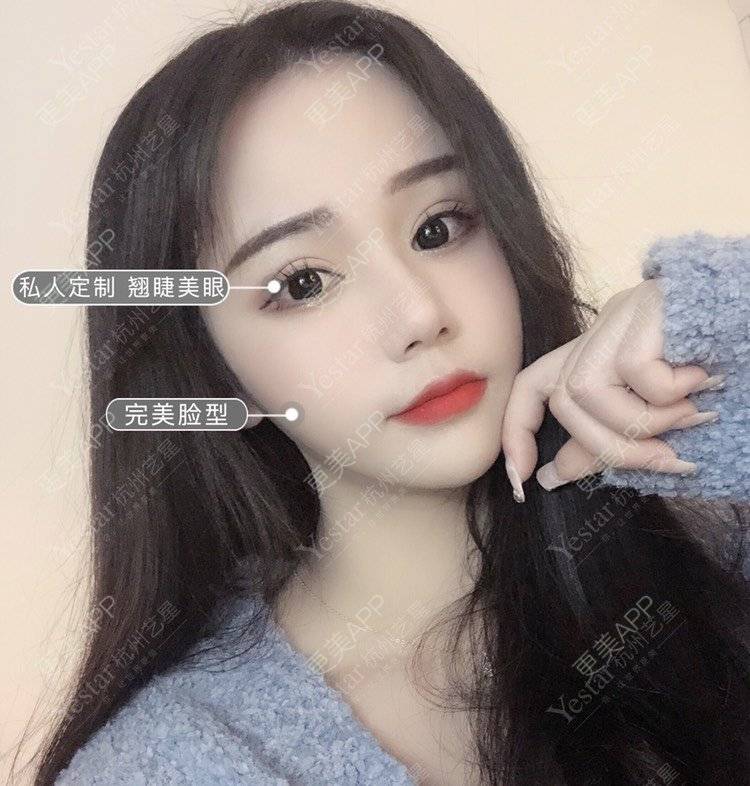 更美 - 杨连华 医生的双眼皮经验 | 视频日记 | 更美研究所 | 杭州 | 双眼皮