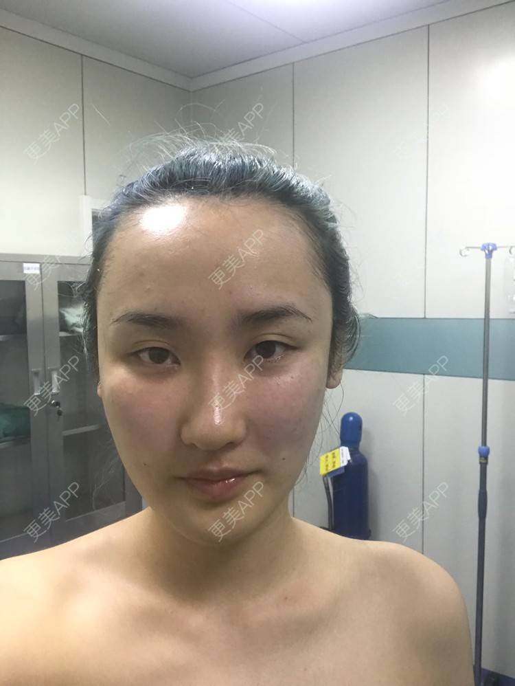 更美 - 哒哒#的自体脂肪填充泪沟经验 | 自体脂肪面部填充 | 自体脂肪填充泪沟 | 自体脂肪填充面部细纹