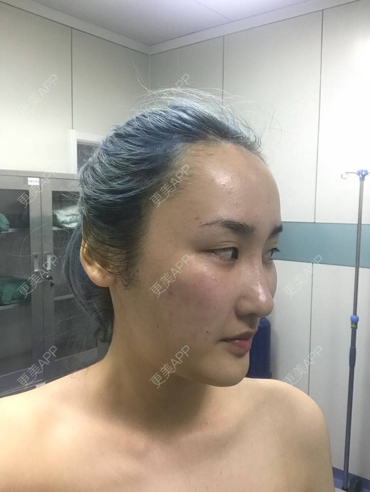 更美 - 哒哒#的自体脂肪填充泪沟经验 | 自体脂肪面部填充 | 自体脂肪填充泪沟 | 自体脂肪填充面部细纹