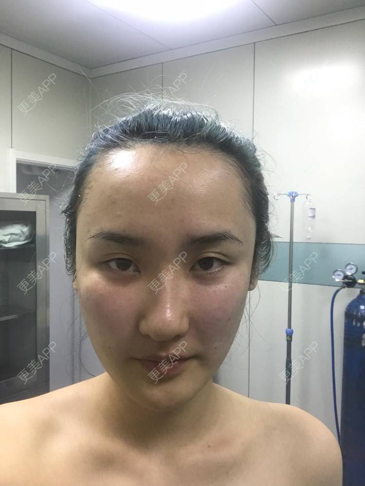 更美 - 哒哒#的自体脂肪填充泪沟经验 | 自体脂肪面部填充 | 自体脂肪填充泪沟 | 自体脂肪填充面部细纹