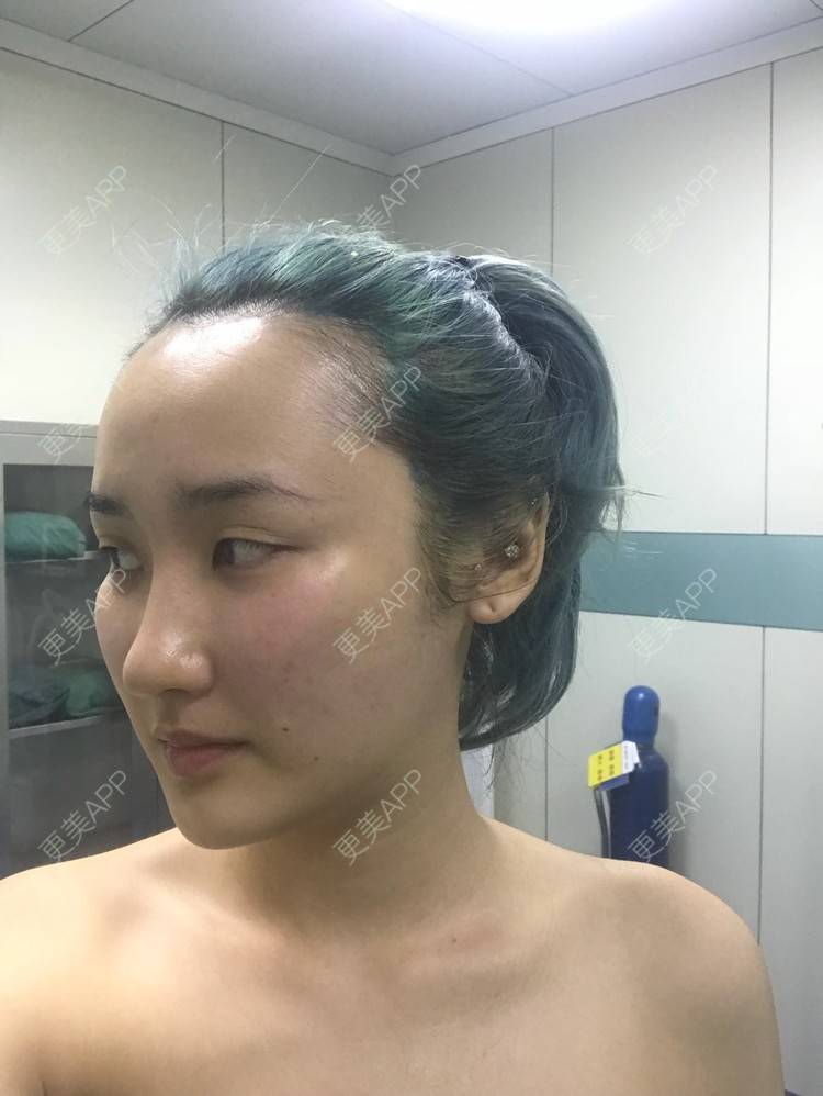 更美 - 哒哒#的自体脂肪填充泪沟经验 | 自体脂肪面部填充 | 自体脂肪填充泪沟 | 自体脂肪填充面部细纹