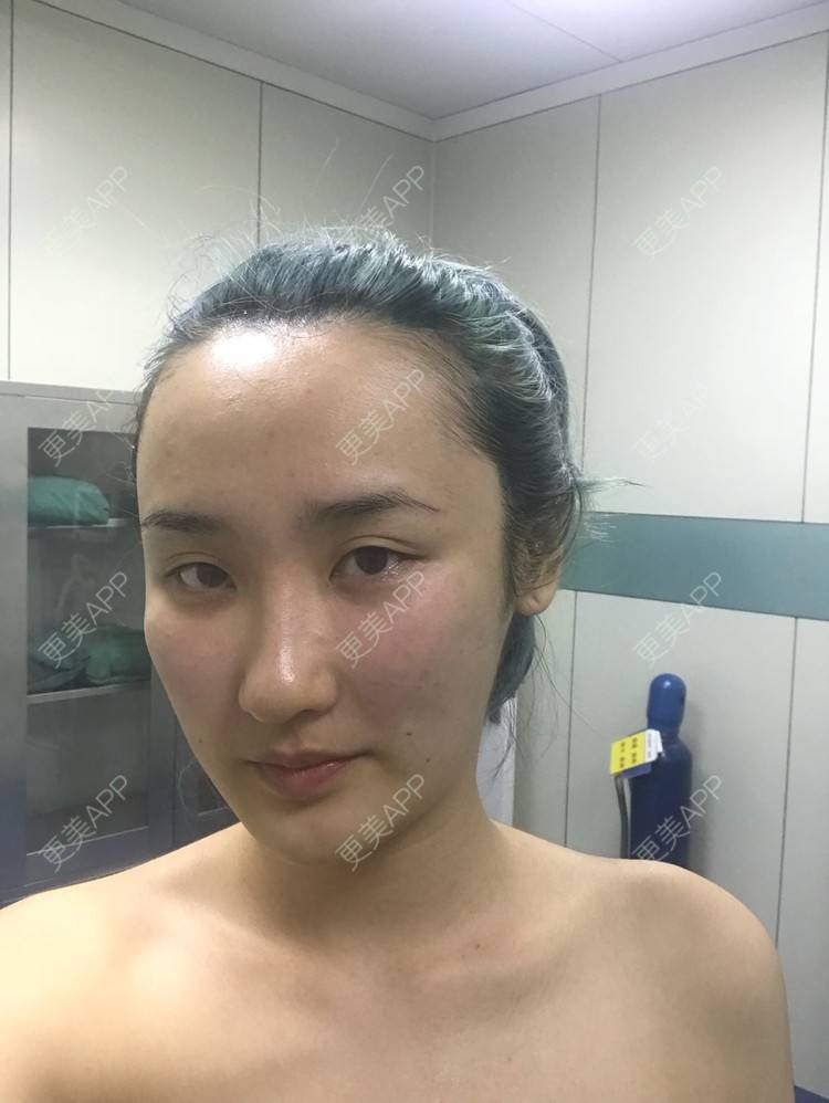 更美 - 哒哒#的自体脂肪填充泪沟经验 | 自体脂肪面部填充 | 自体脂肪填充泪沟 | 自体脂肪填充面部细纹